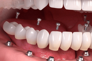Chi phí làm răng giả cố định tại Nha Khoa Kim bao nhiêu?