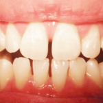 Răng thưa nên làm gì? 3 Cách khắc phục răng thưa an toàn