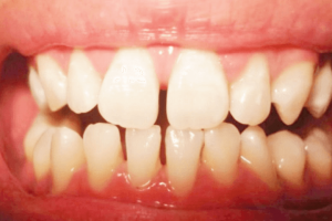 Răng thưa nên làm gì? 3 Cách khắc phục răng thưa an toàn
